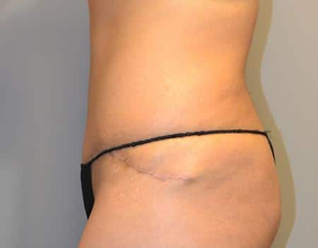 Tummy Tuck Before & After Case 3836