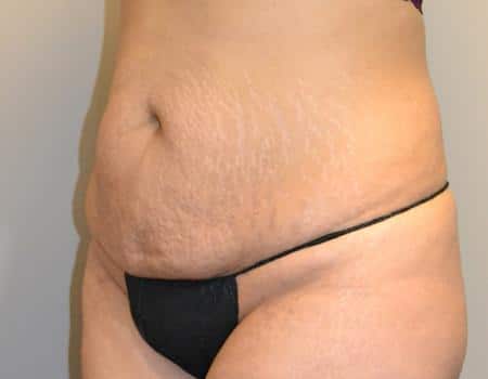 Tummy Tuck Before & After Case 3836