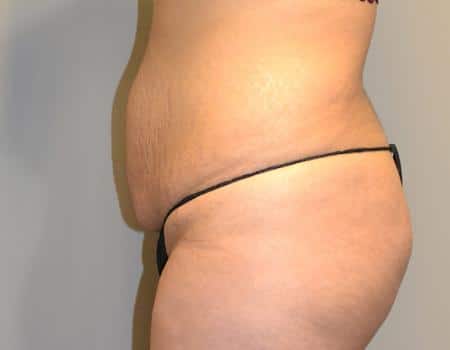 Tummy Tuck Before & After Case 3836