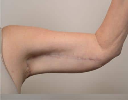 Arm Lift Before & After Case 4050
