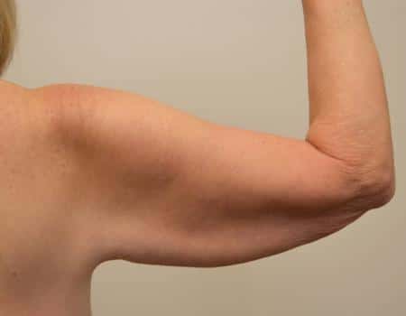 Arm Lift Before & After Case 4050