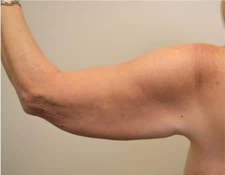 Arm Lift Before & After Case 4050