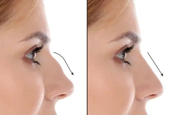 Nose Shape and Size after Rhinoplasty