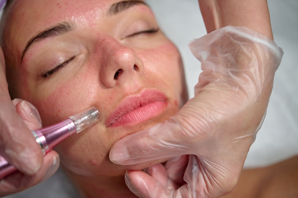 Cosmetician performing a SkinPen® microneedling treatment, using a dermapen to stimulate collagen production for smoother, rejuvenated skin.