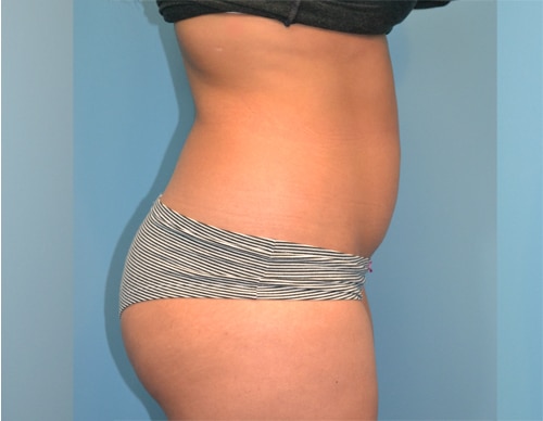 Smartlipo Before & After Case 4355