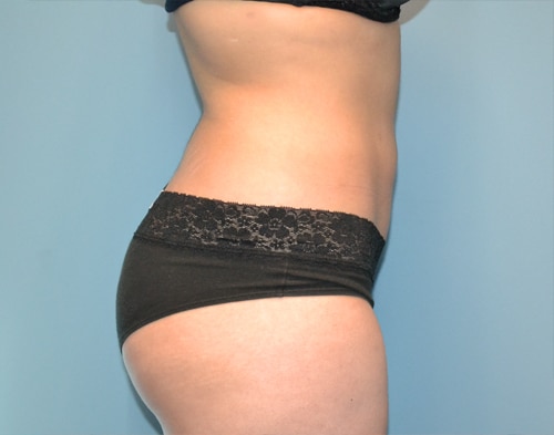 Smartlipo Before & After Case 4355