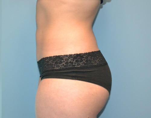 Smartlipo Before & After Case 4355