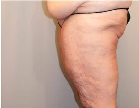 Thigh Lift Before & After Case 4042