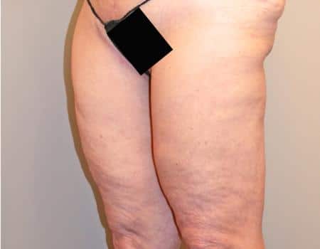 Thigh Lift Before & After Case 4042