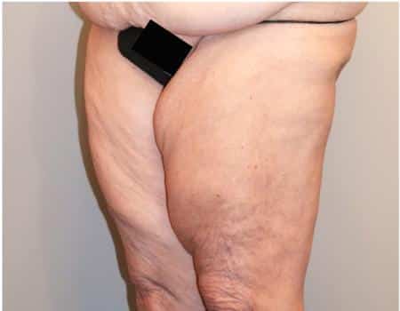 Thigh Lift Before & After Case 4042