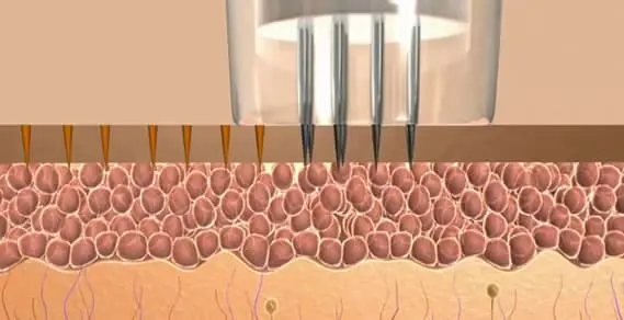 Introducing Micro-needling Treatments