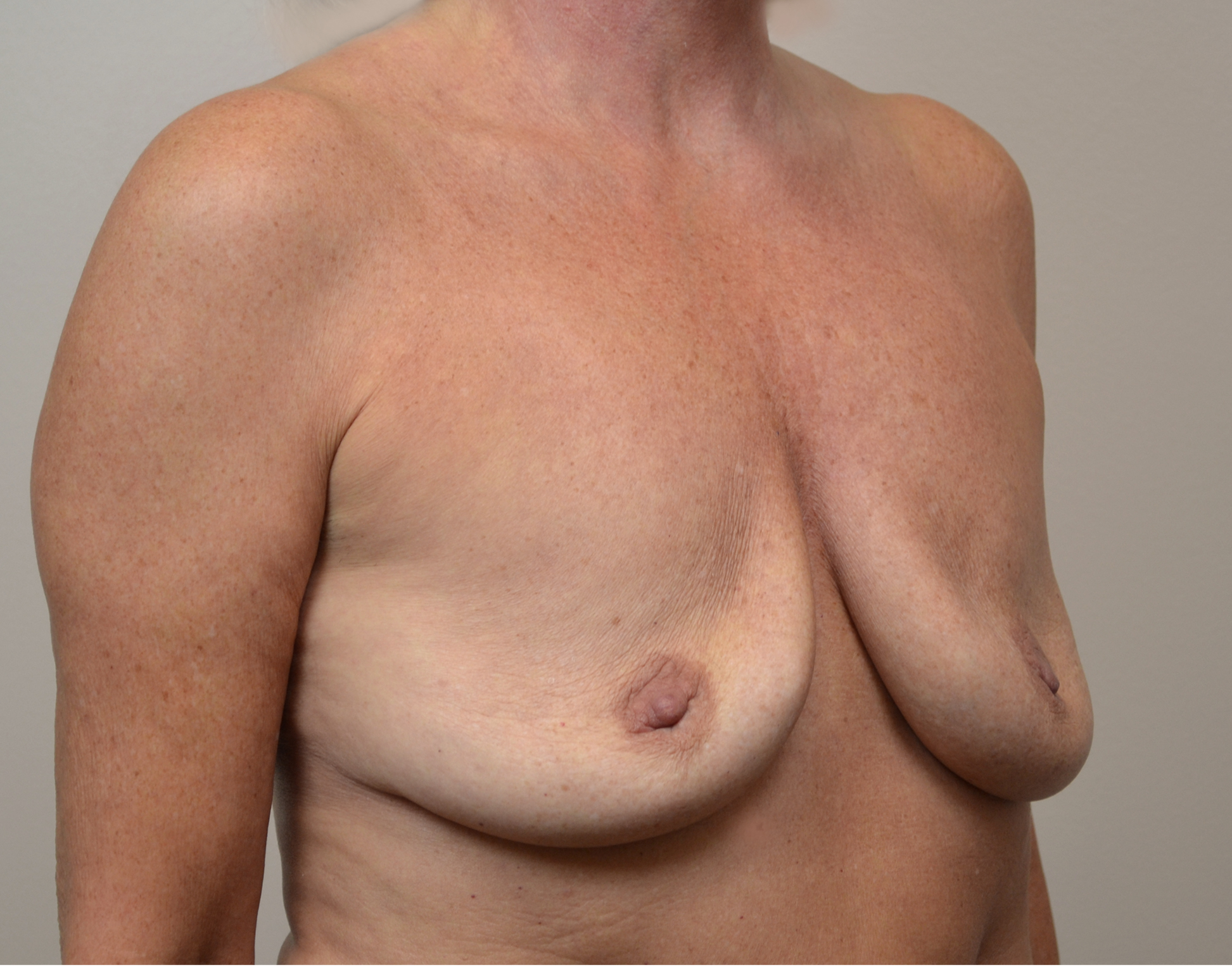 Breast Lift Before & After Case 8018