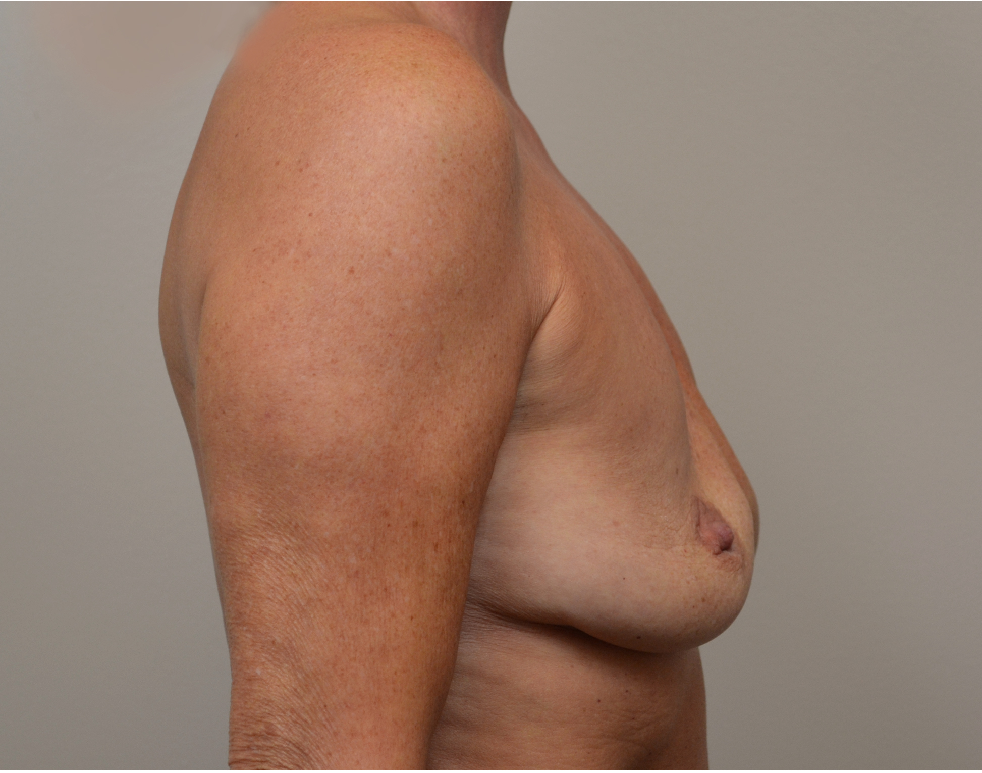 Breast Lift Before & After Case 8018