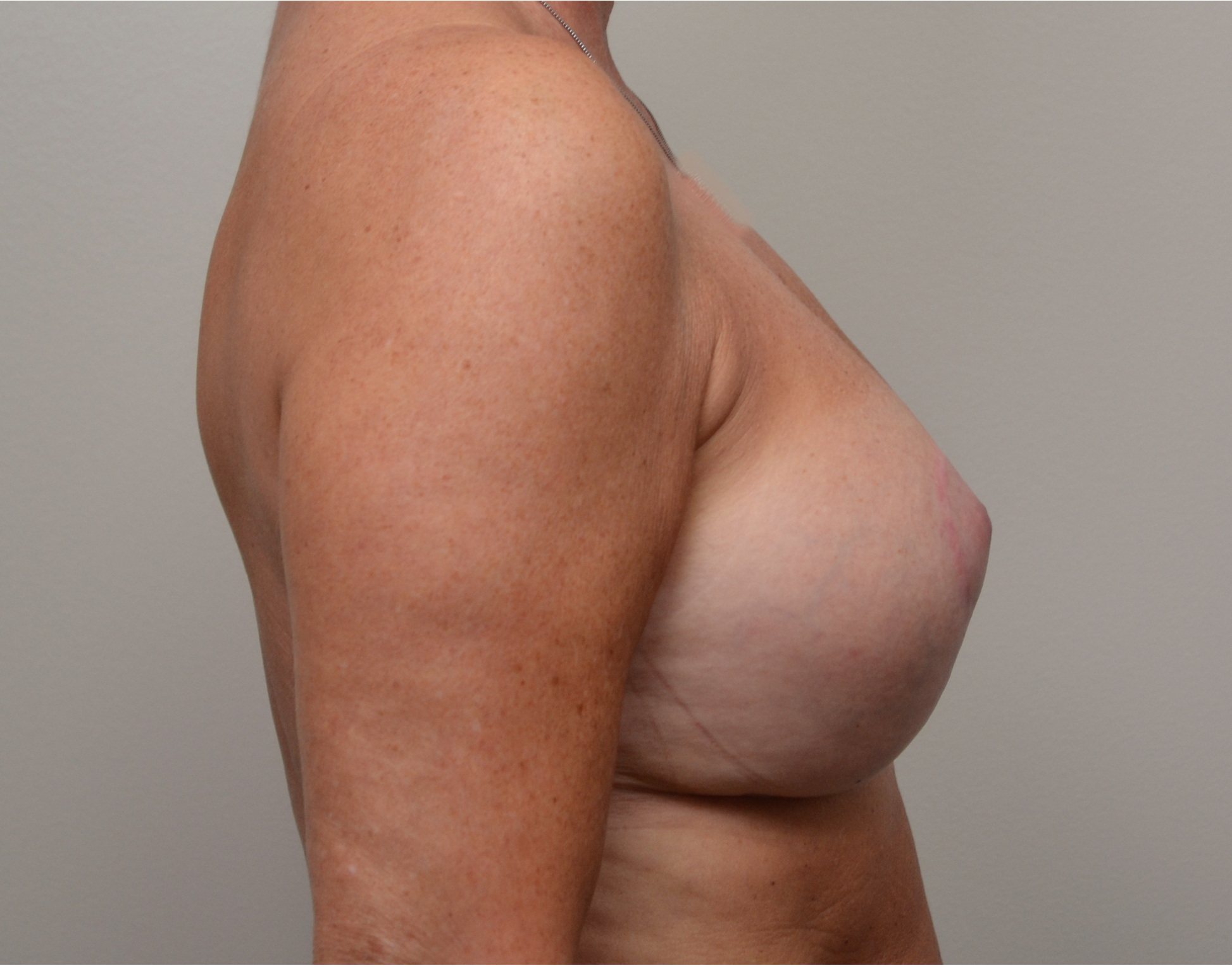 Breast Lift Before & After Case 8018