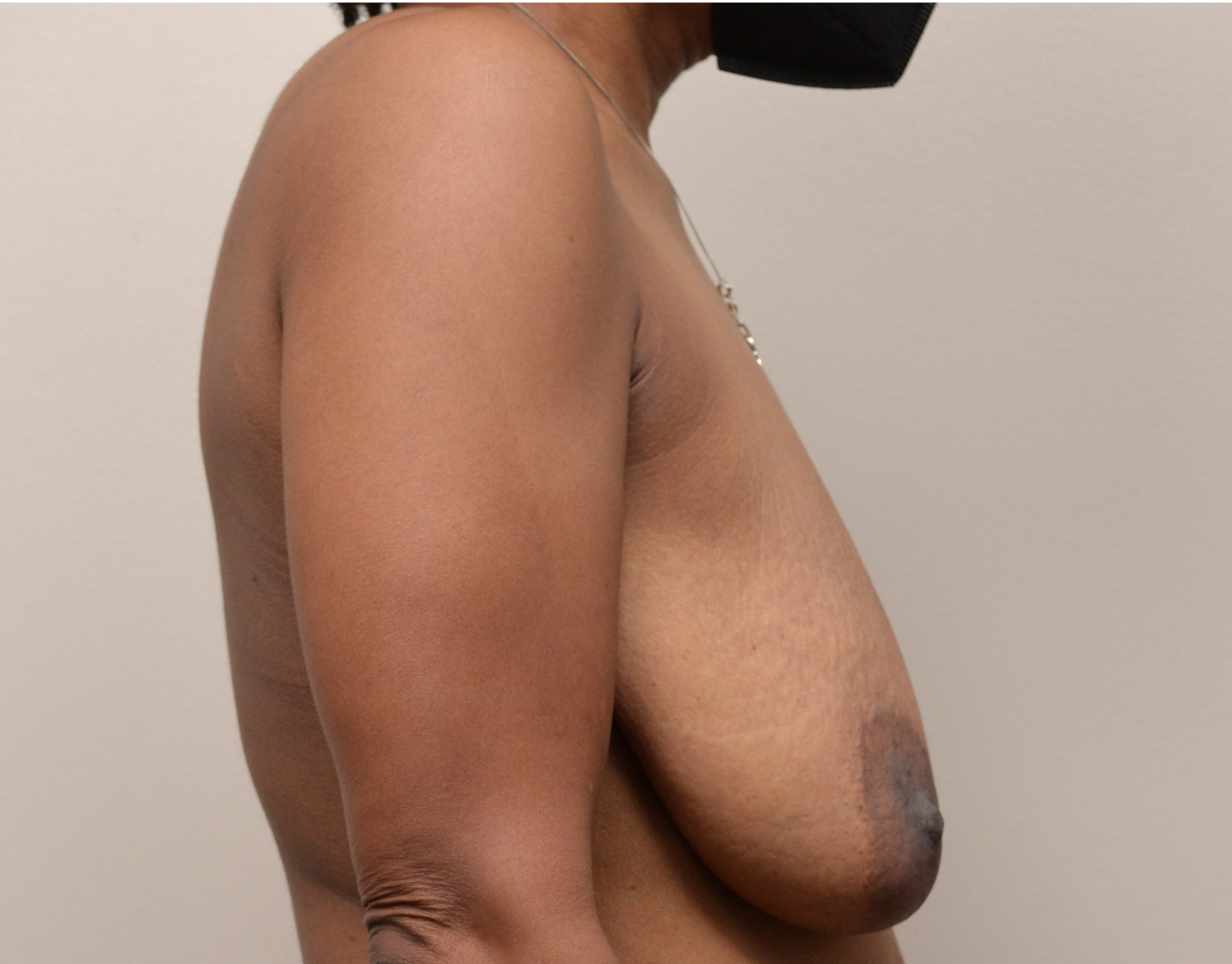 Breast Lift Before & After Case 8019