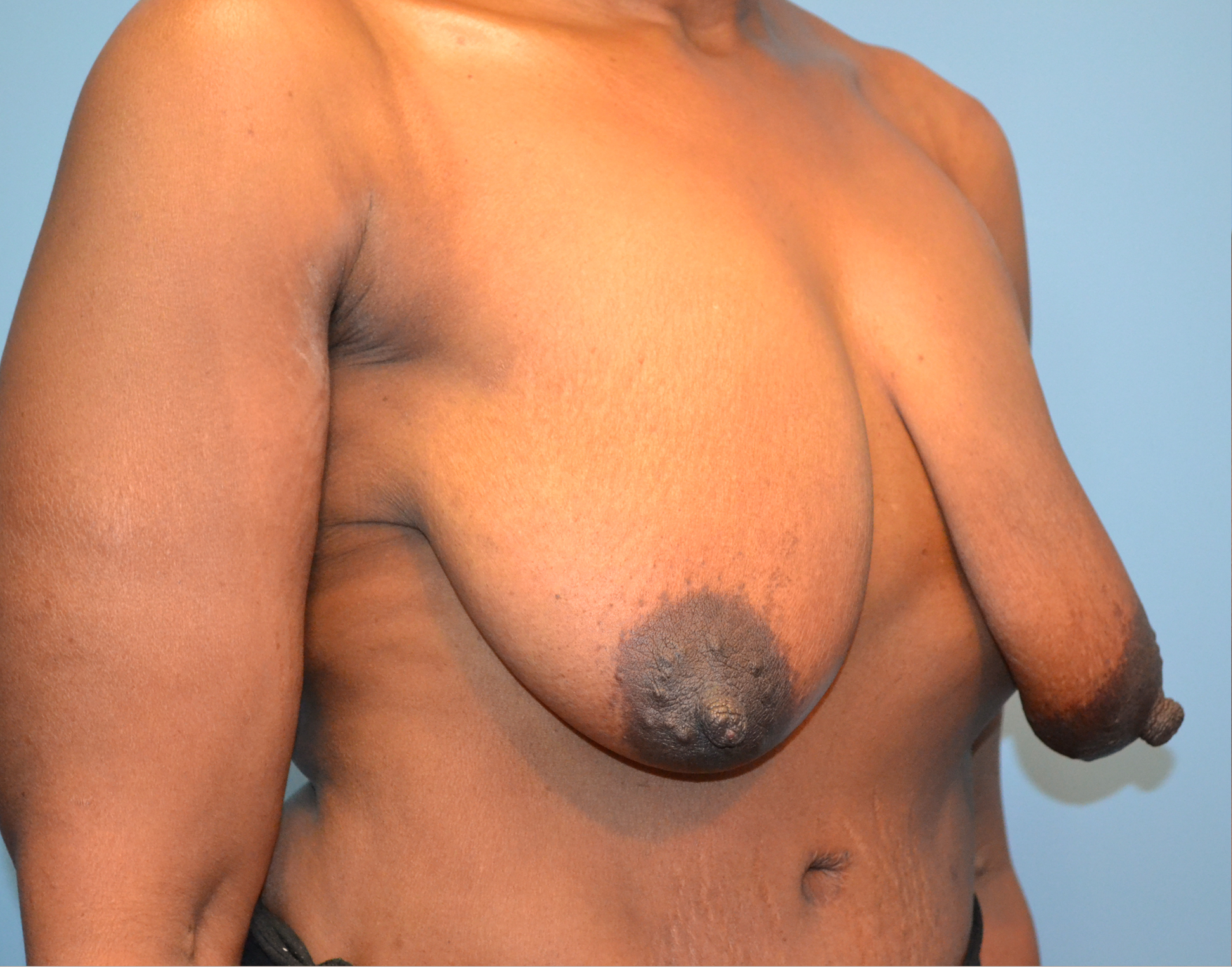 Breast Lift Before & After Case 8020