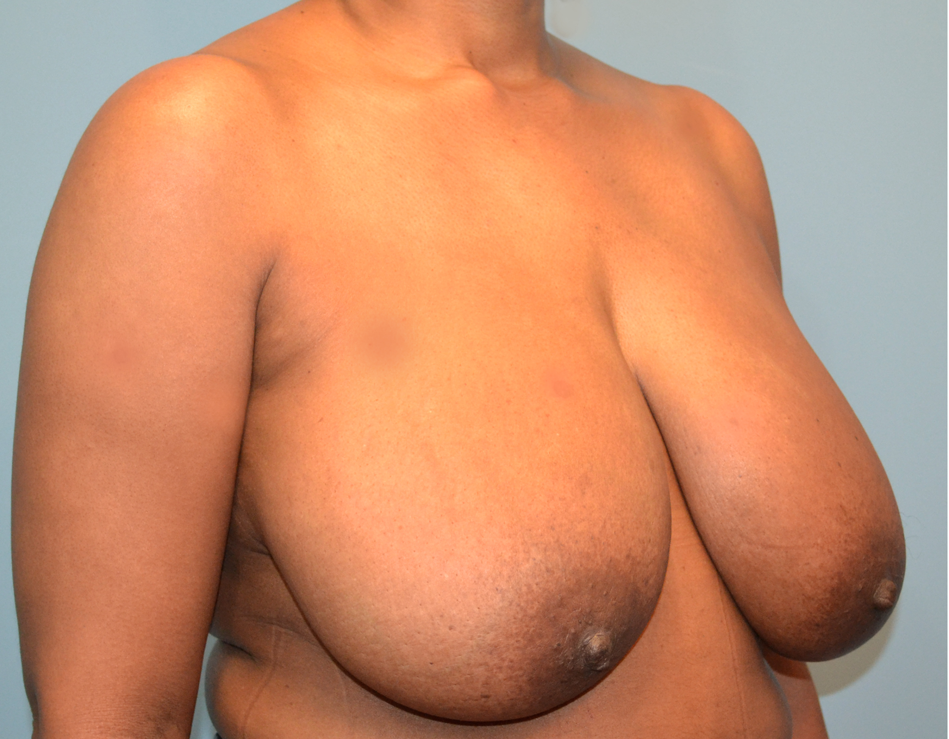 Breast Reduction Before & After Case 3093
