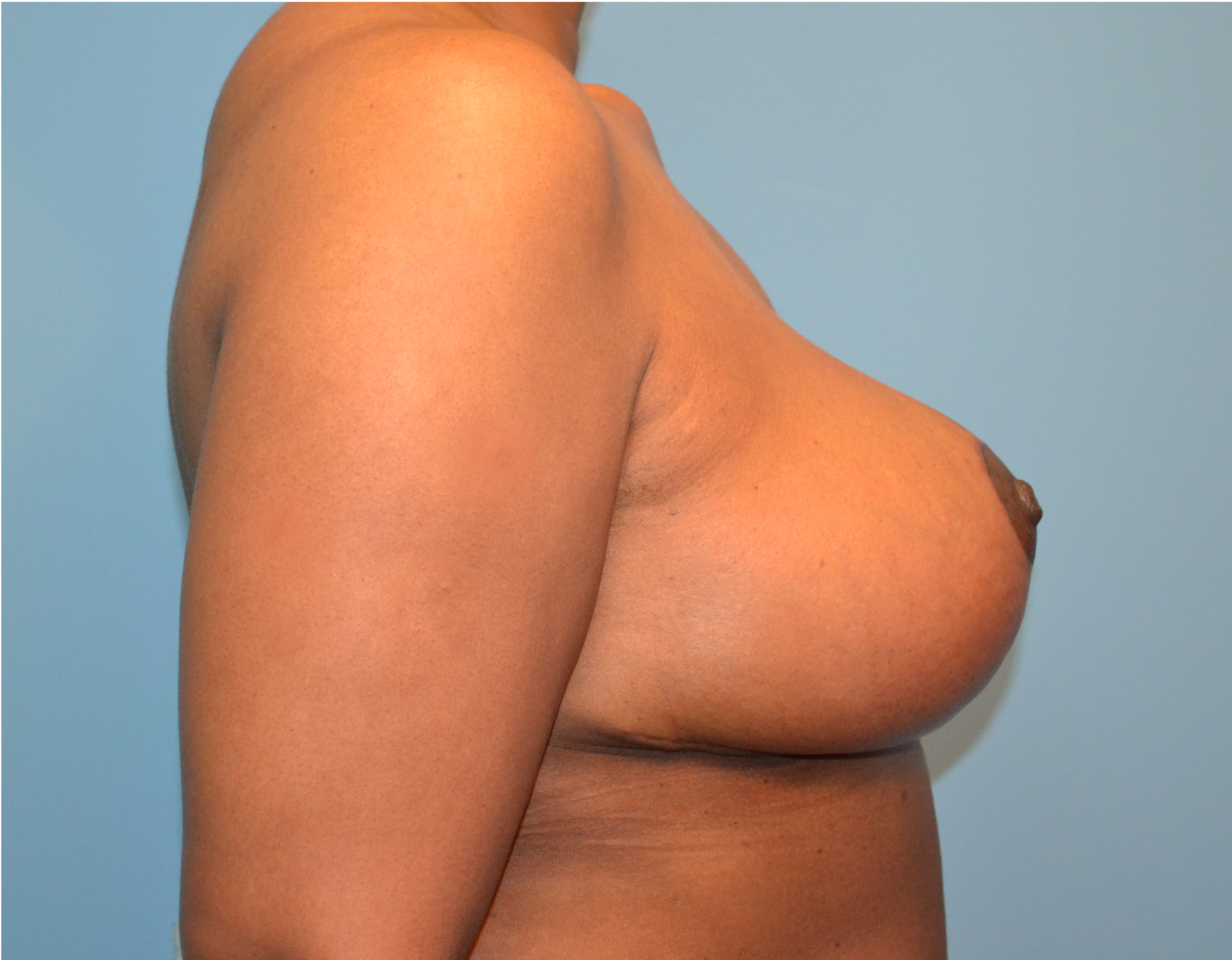 Breast Reduction Before & After Case 3093