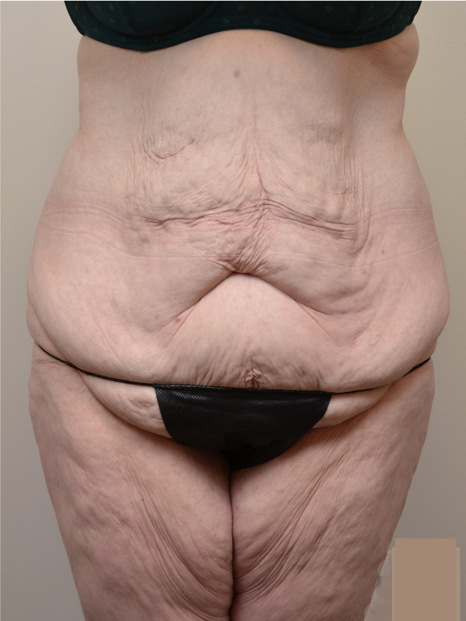 Fleur-de-Lis Tummy Tuck  Before & After Case 7710
