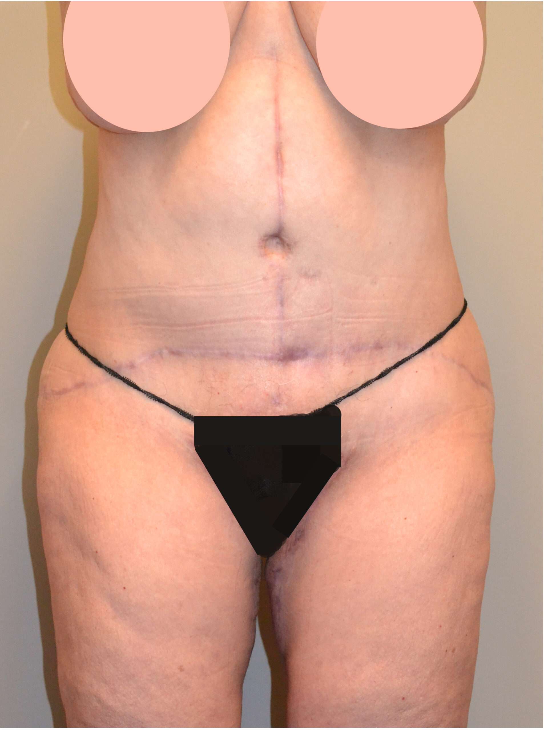 Fleur-de-Lis Tummy Tuck  Before & After Case 7712