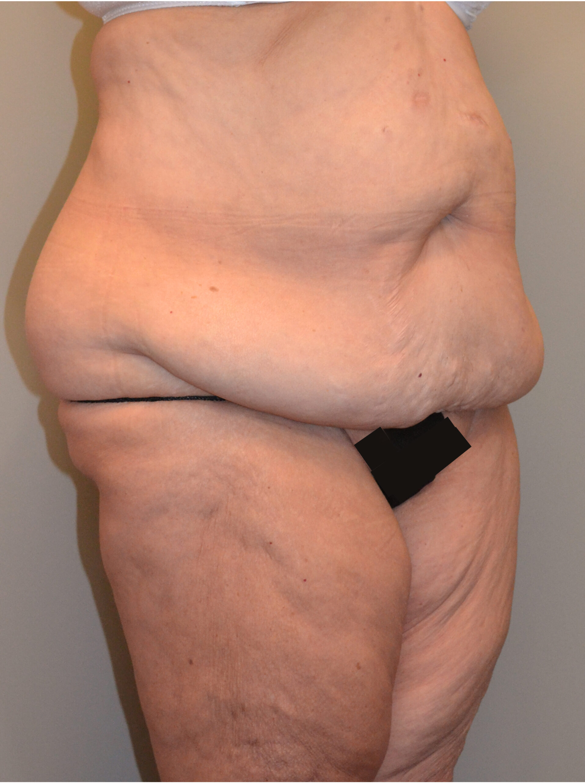 Fleur-de-Lis Tummy Tuck  Before & After Case 7712