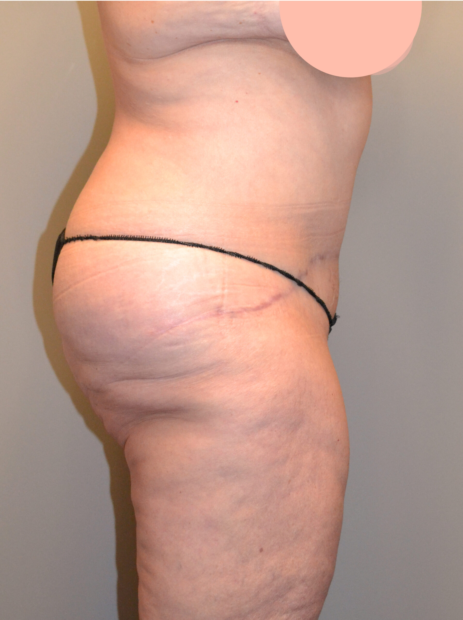 Fleur-de-Lis Tummy Tuck  Before & After Case 7712
