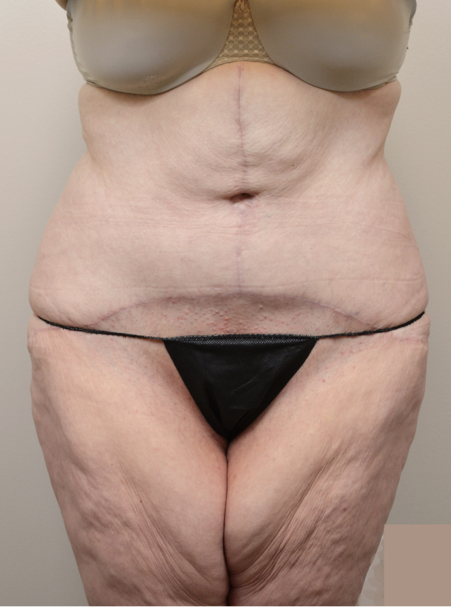 Fleur-de-Lis Tummy Tuck  Before & After Case 7710