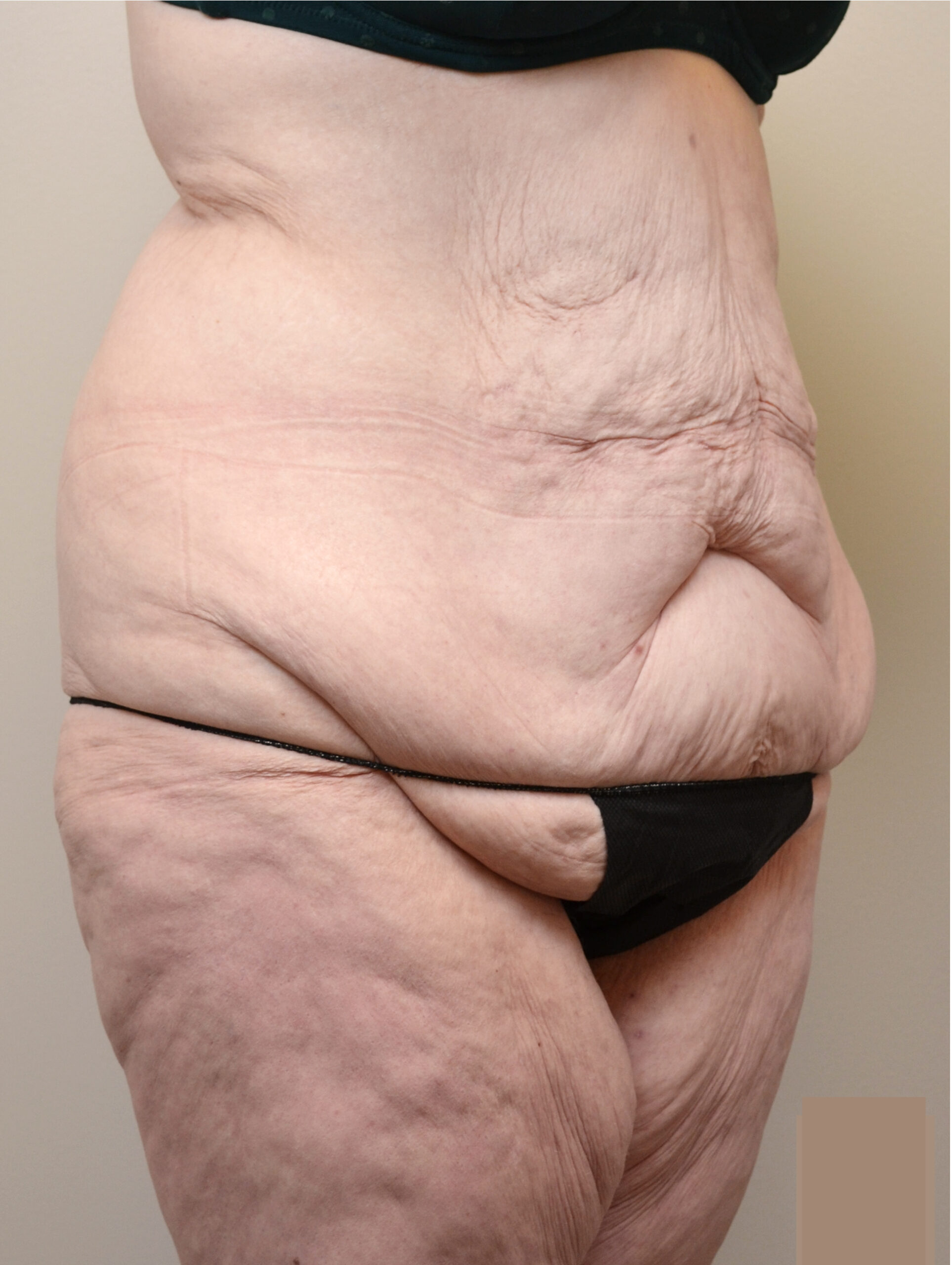 Fleur-de-Lis Tummy Tuck  Before & After Case 7710
