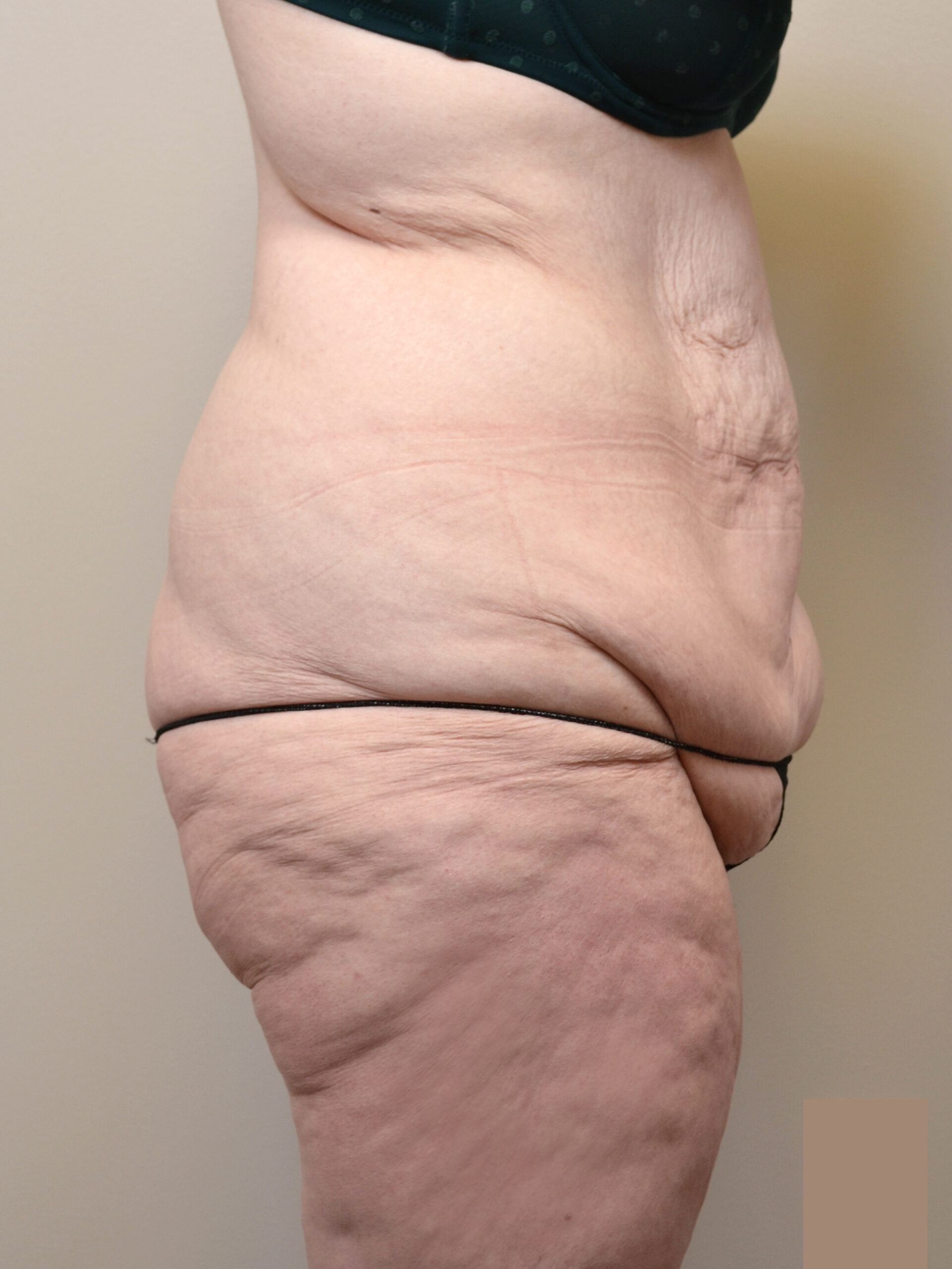 Fleur-de-Lis Tummy Tuck  Before & After Case 7710