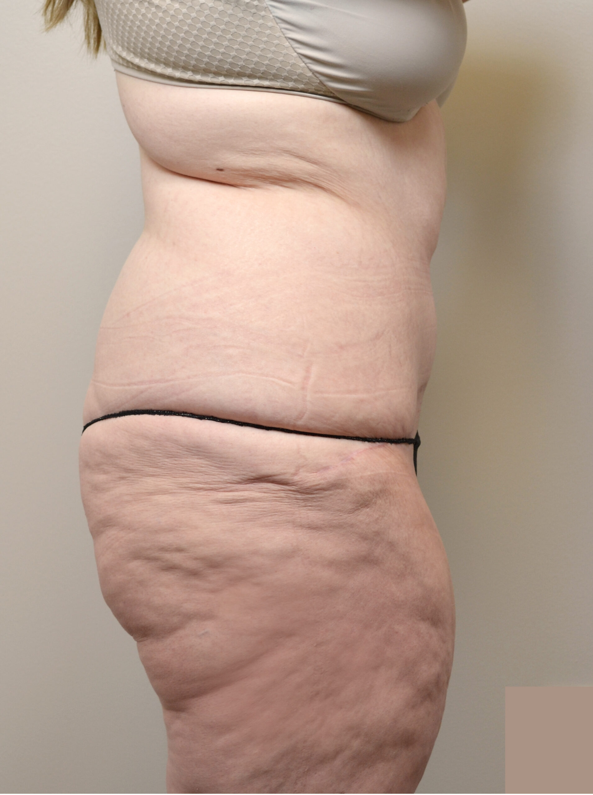 Fleur-de-Lis Tummy Tuck  Before & After Case 7710