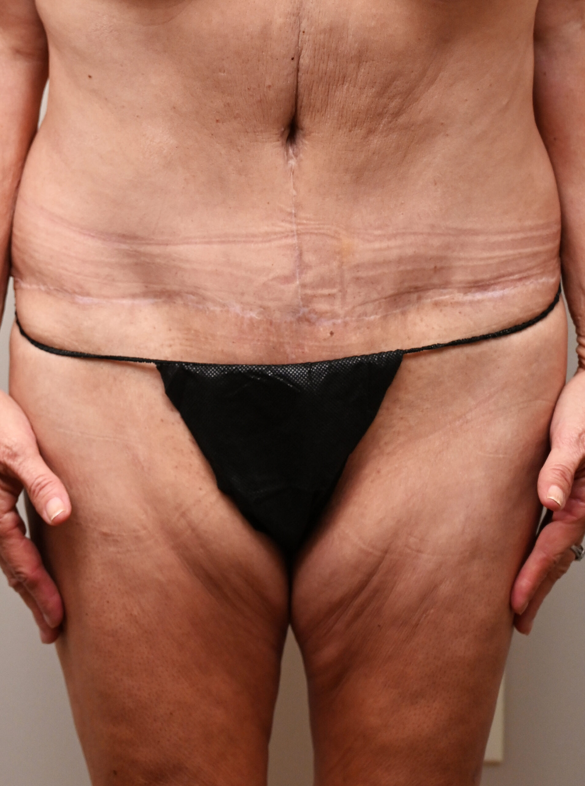 Fleur-de-Lis Tummy Tuck  Before & After Case 7711