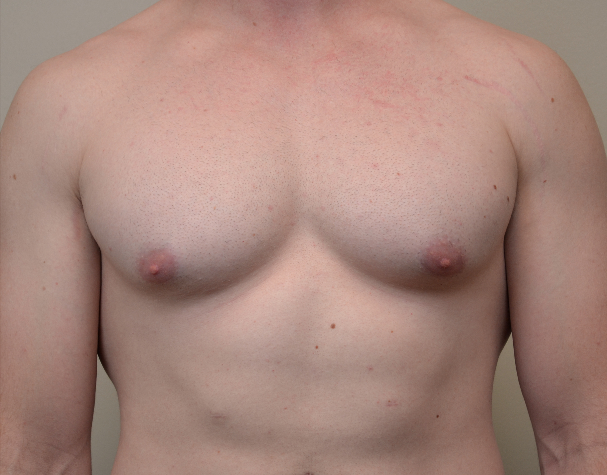 Gynecomastia Before & After Case 1