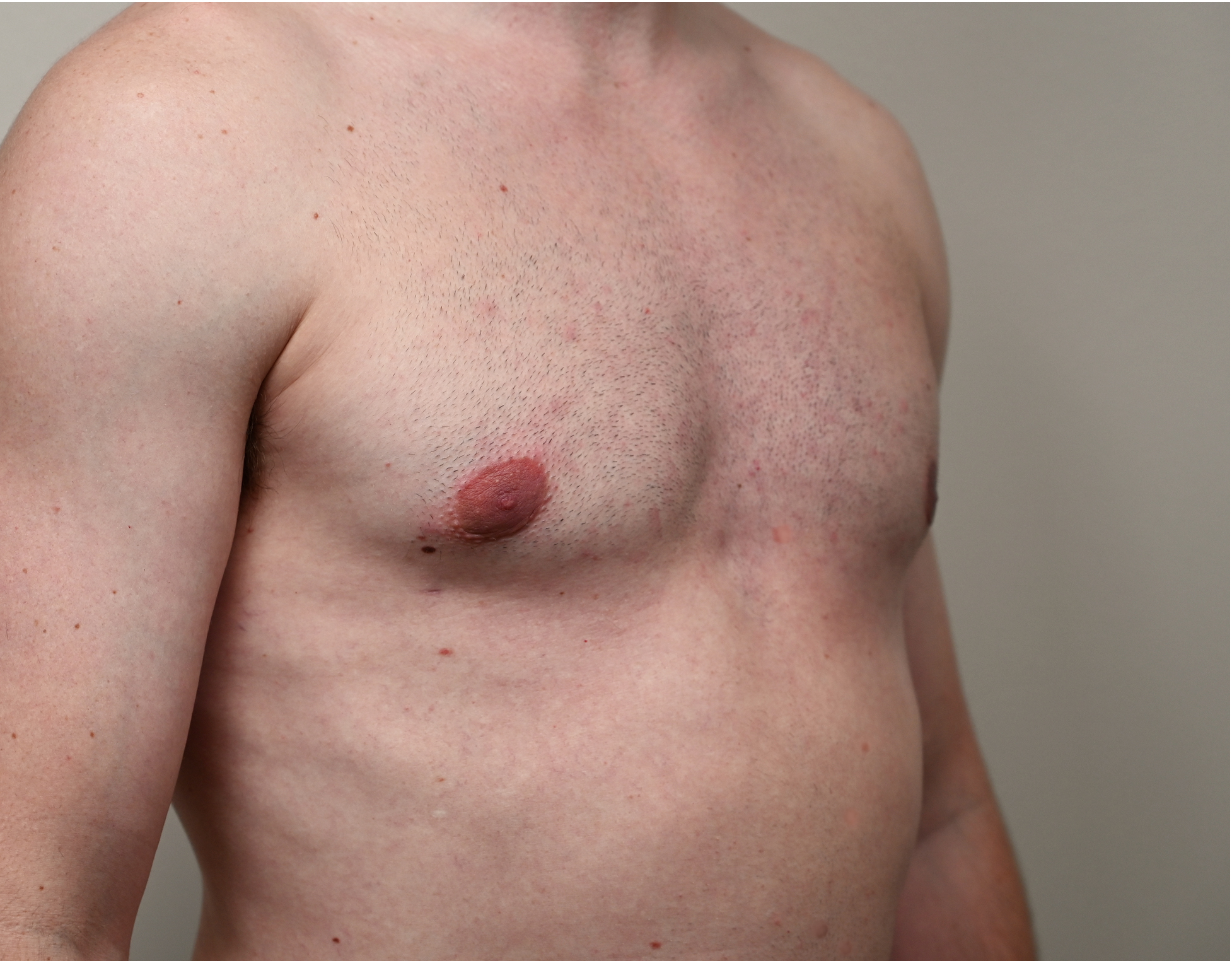 Gynecomastia Before & After Case 2