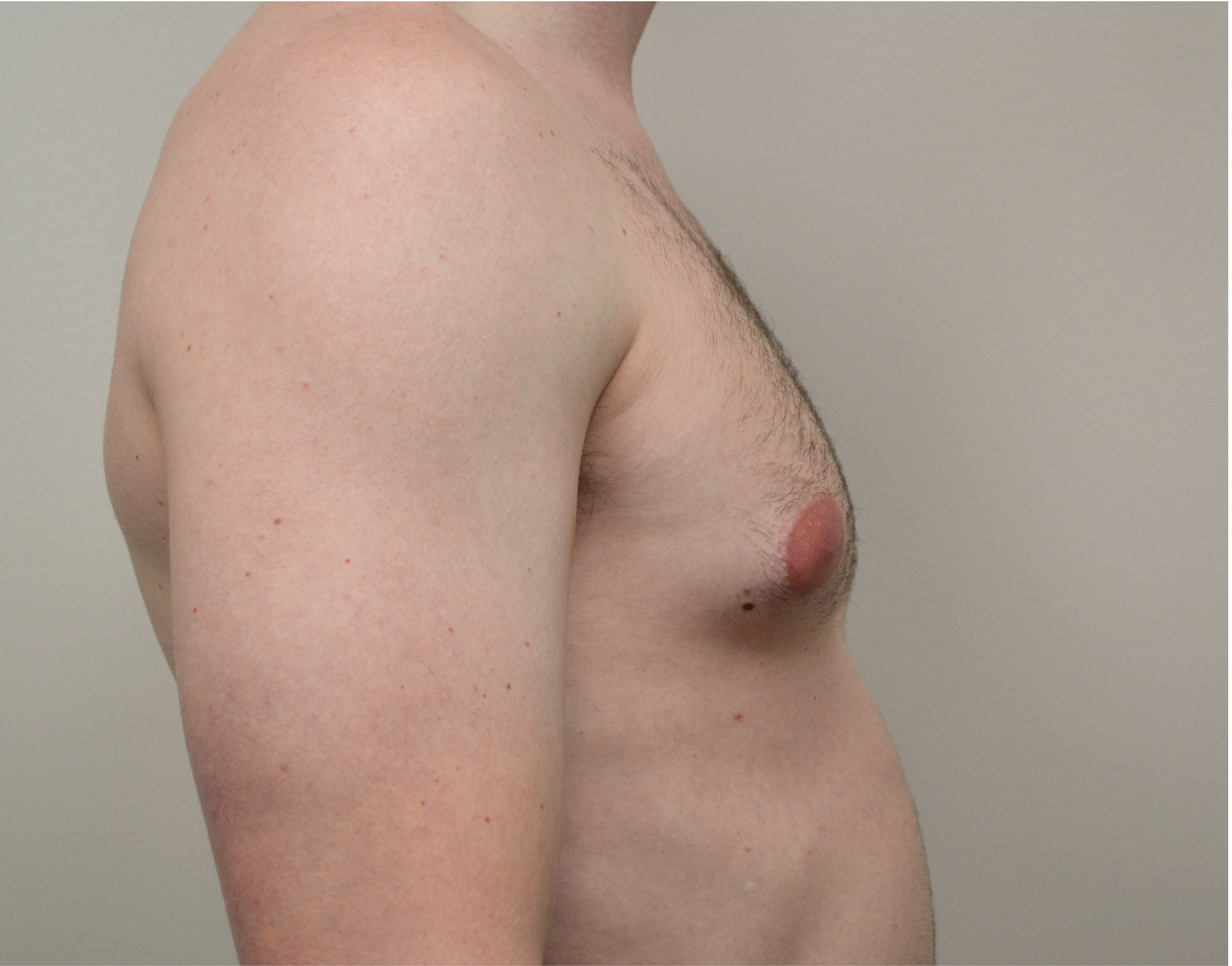 Gynecomastia Before & After Case 2
