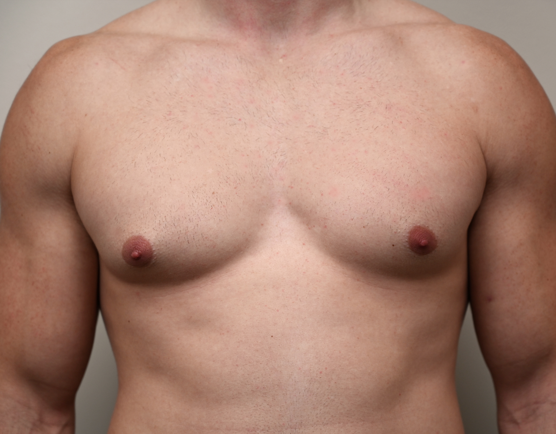 Gyno 13