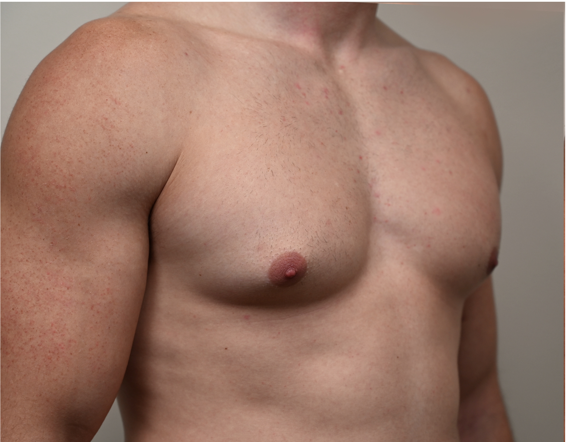 Gynecomastia Before & After Case 3