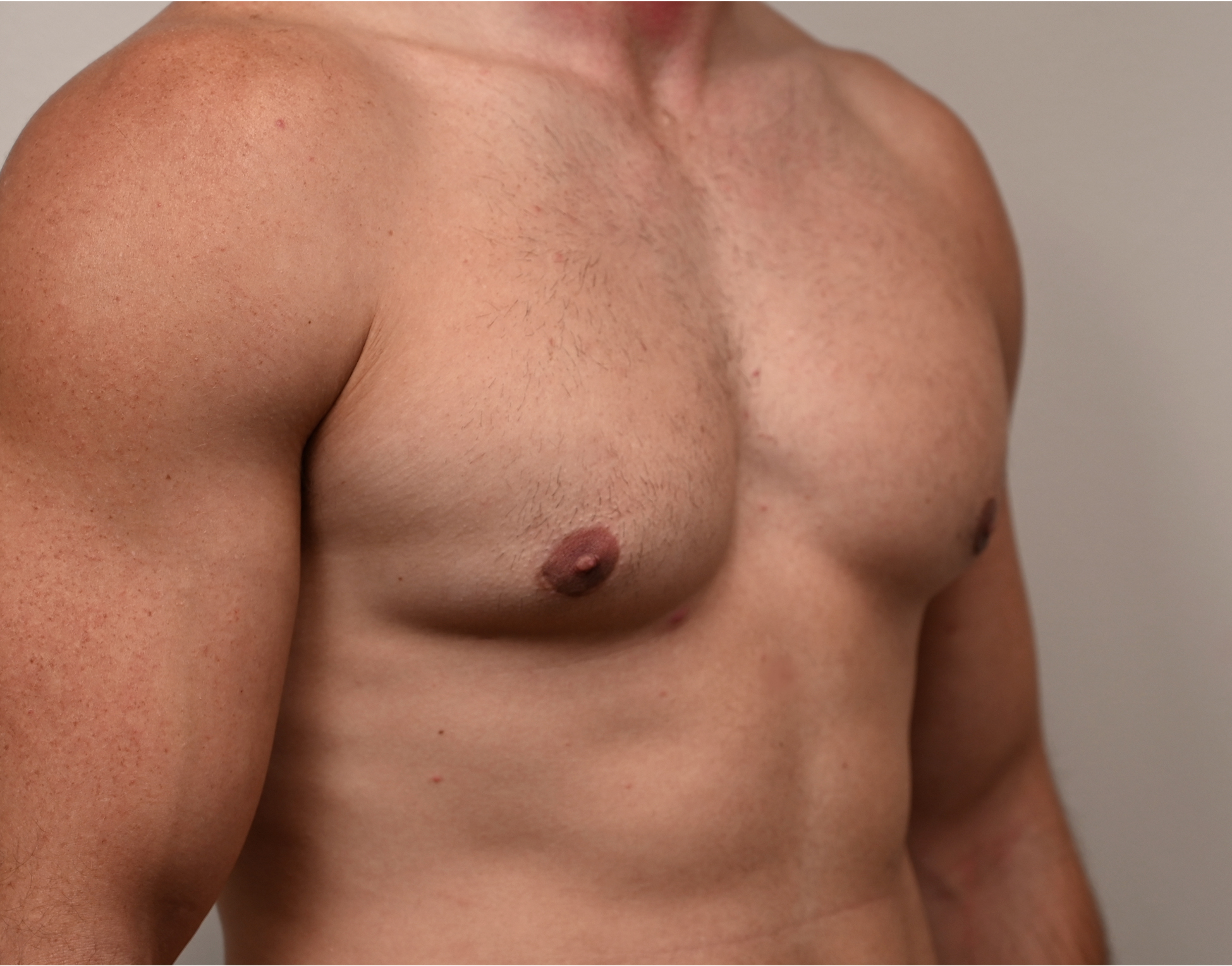 Gynecomastia Before & After Case 3