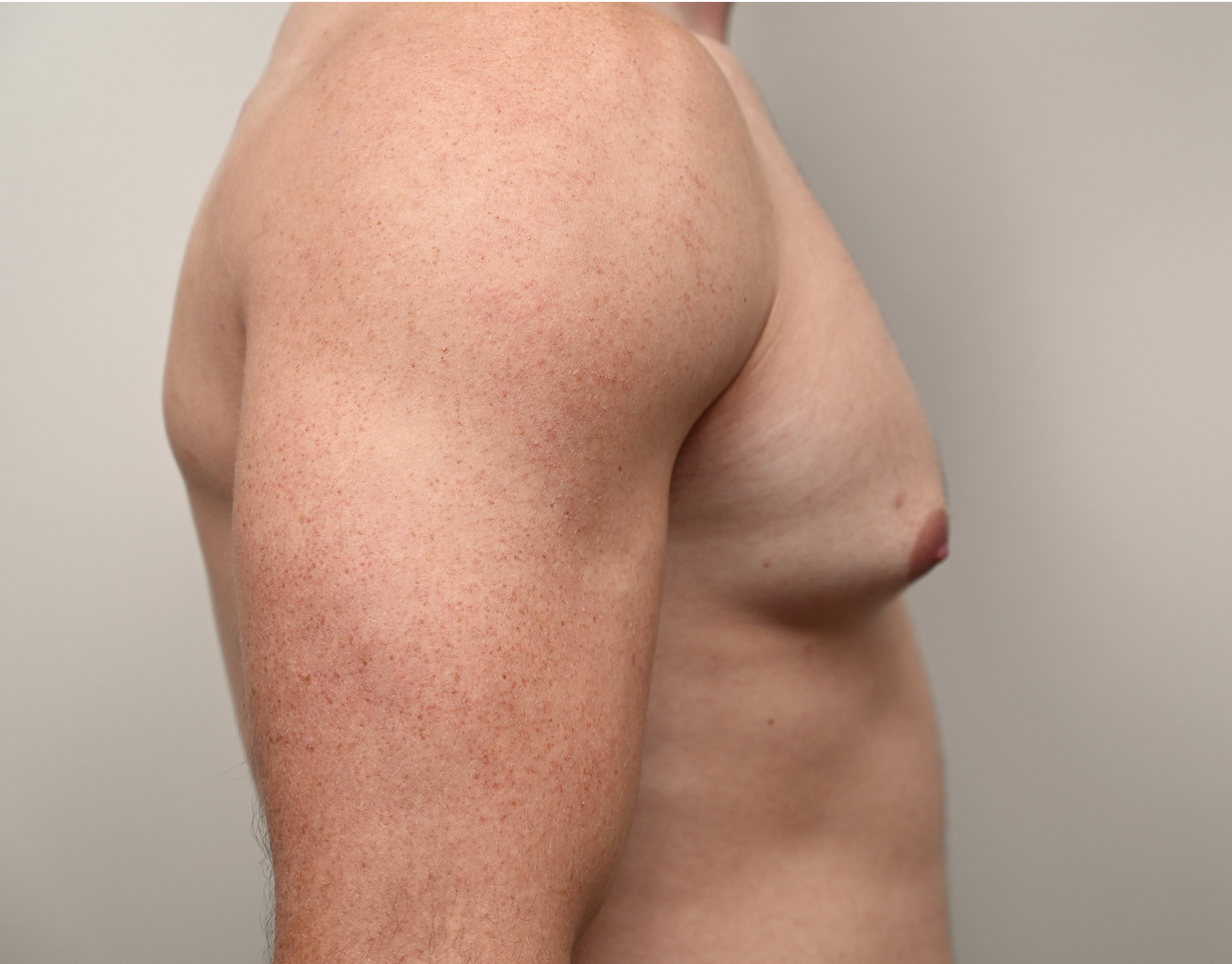 Gynecomastia Before & After Case 3