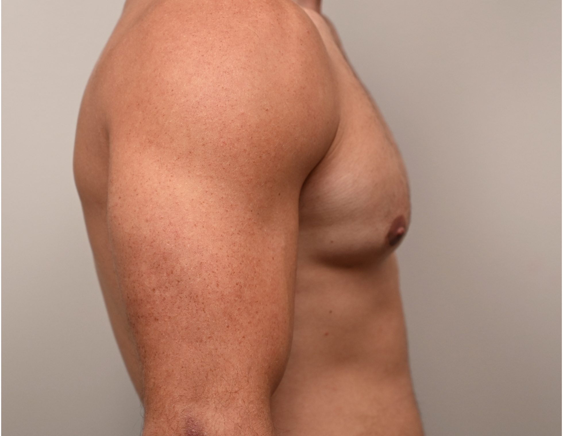 Gynecomastia Before & After Case 3