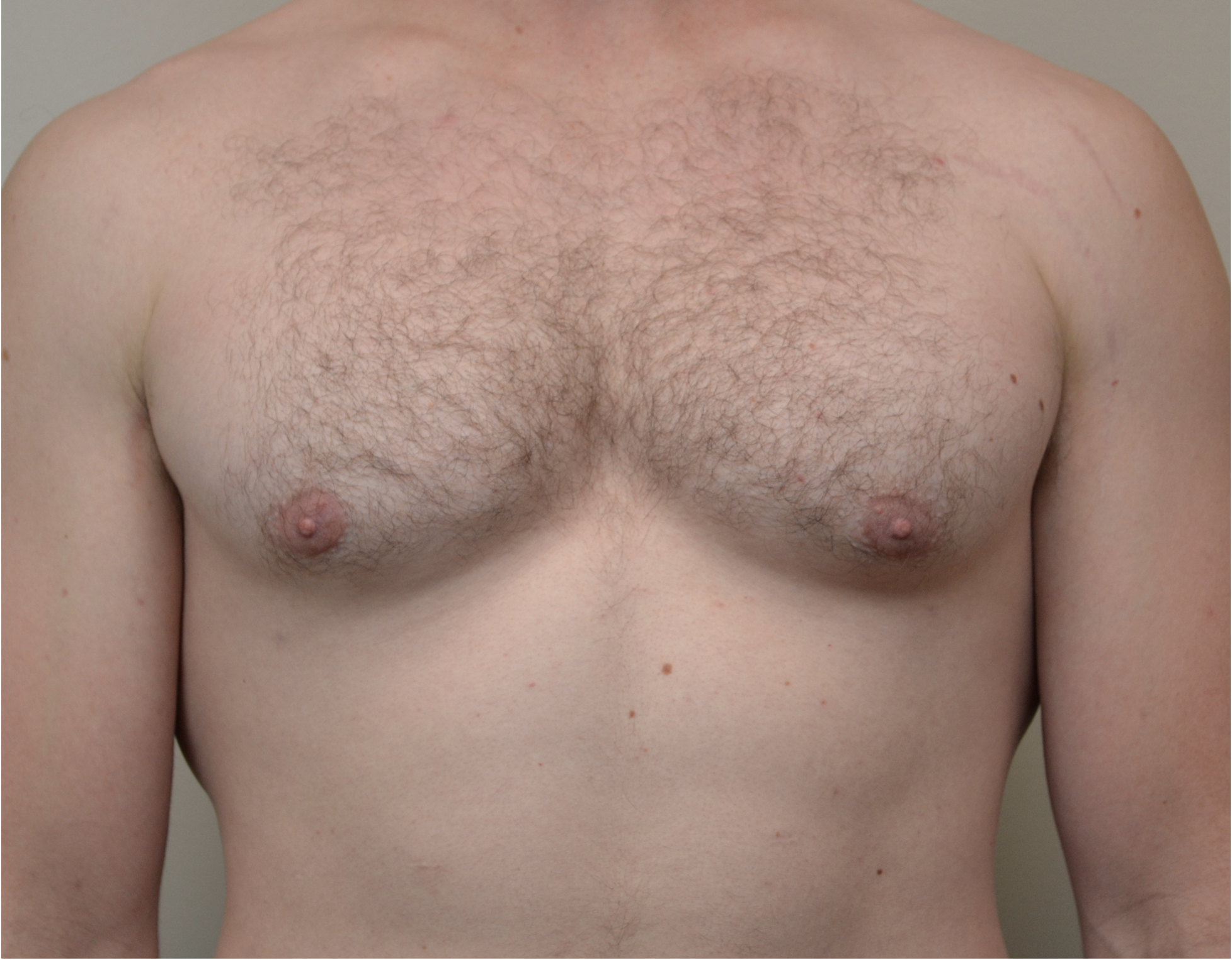 Gynecomastia Before & After Case 1