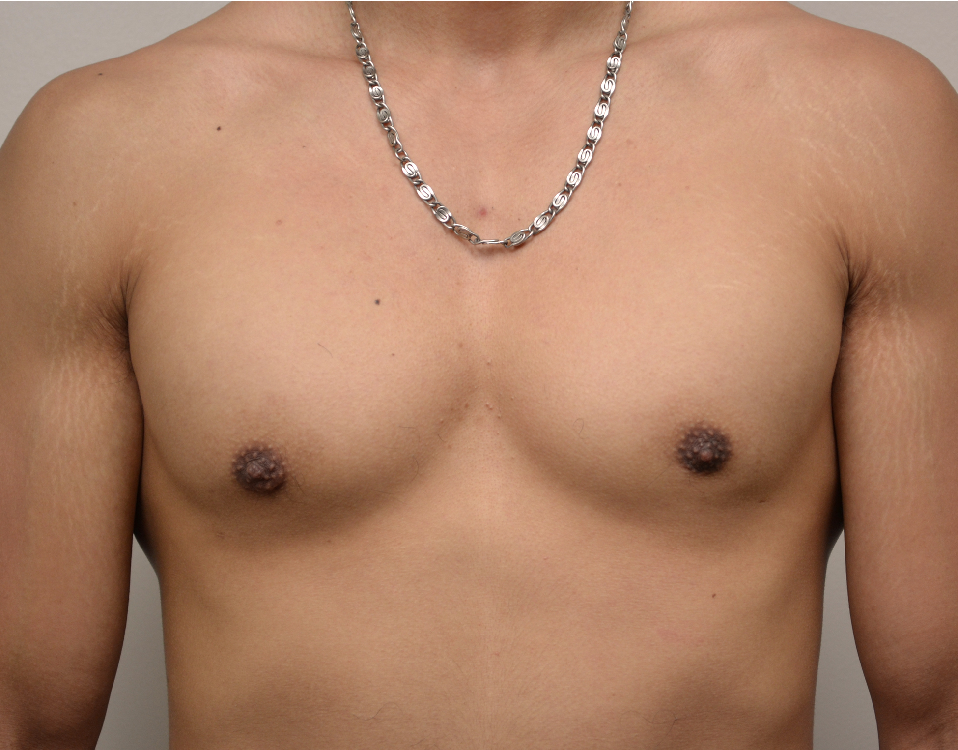 Gynecomastia Before & After Case 4