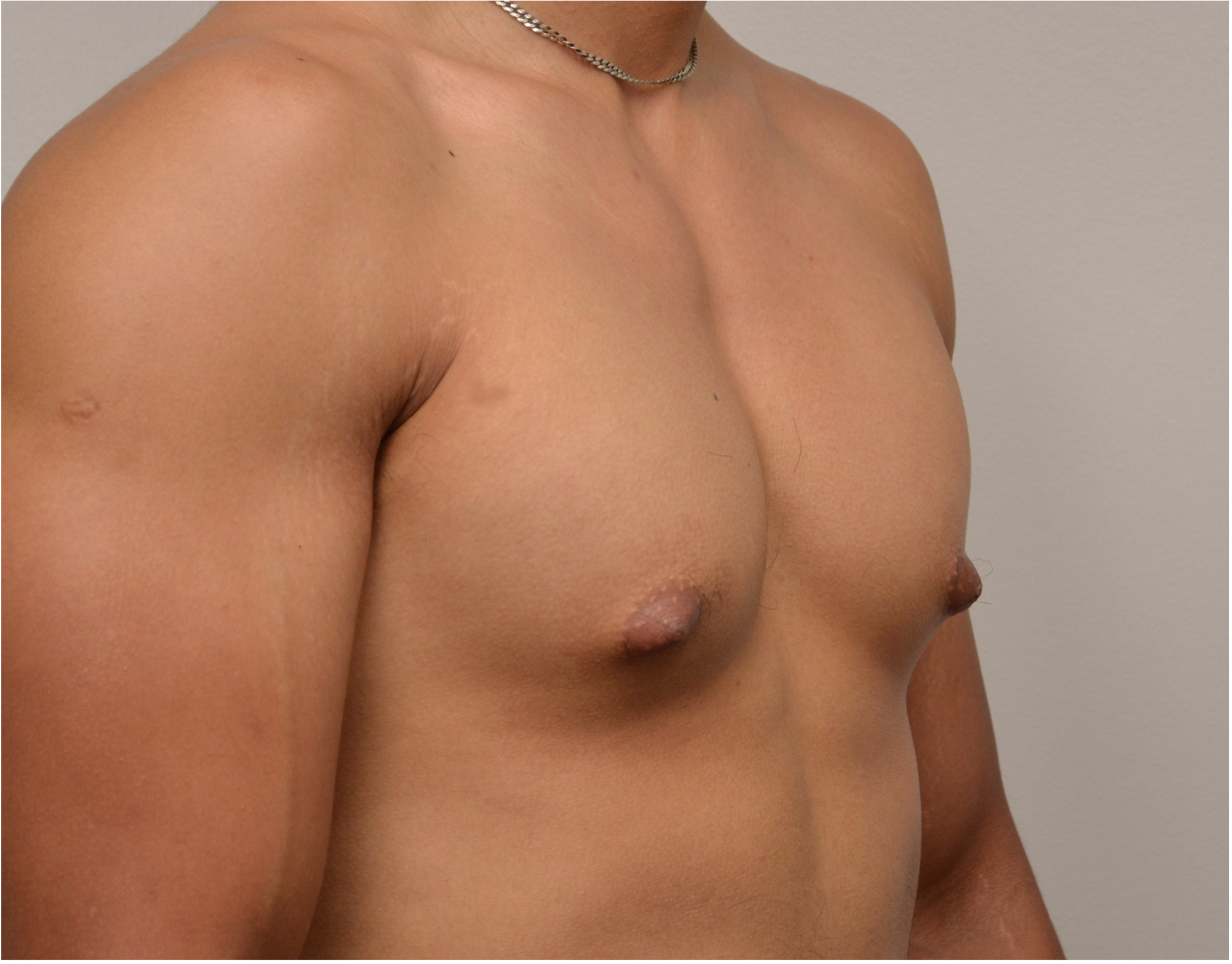 Gynecomastia Before & After Case 4