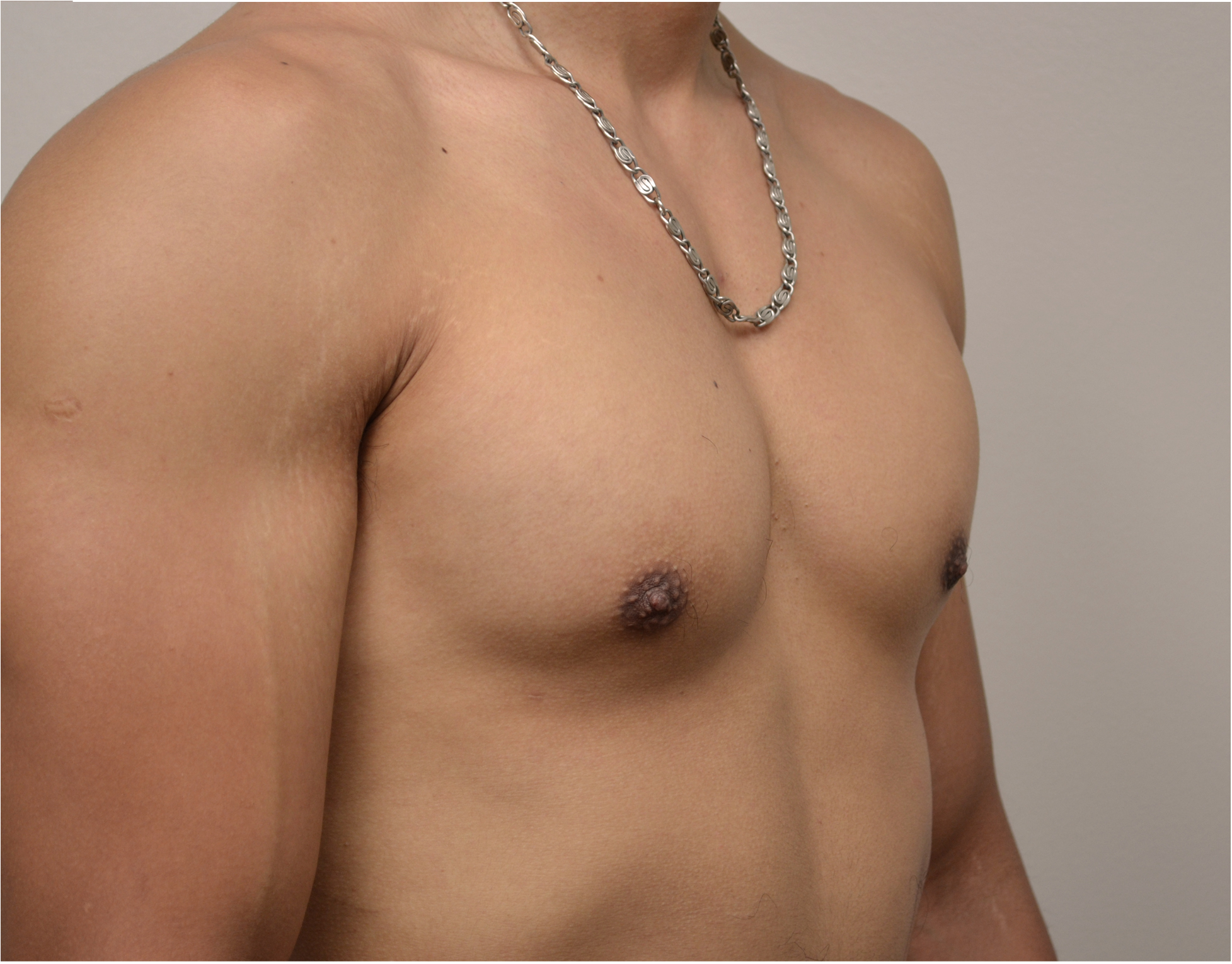 Gynecomastia Before & After Case 4