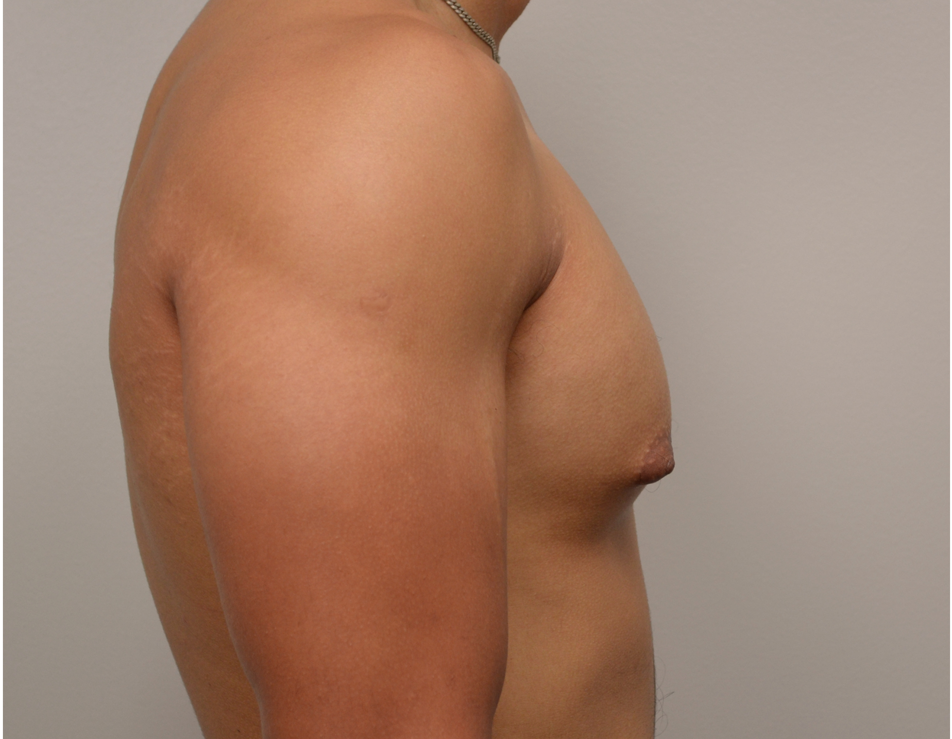 Gynecomastia Before & After Case 4