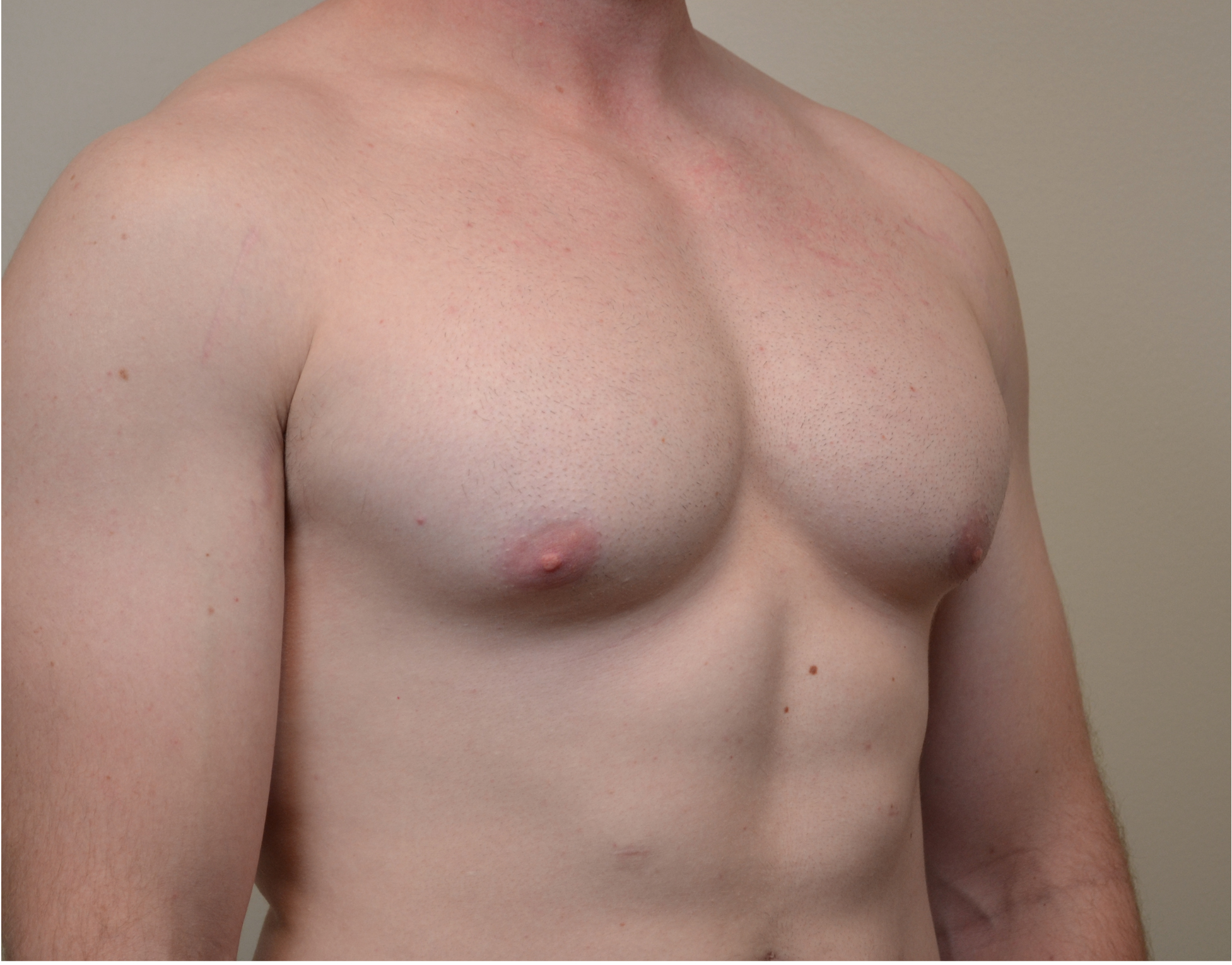 Gynecomastia Before & After Case 1