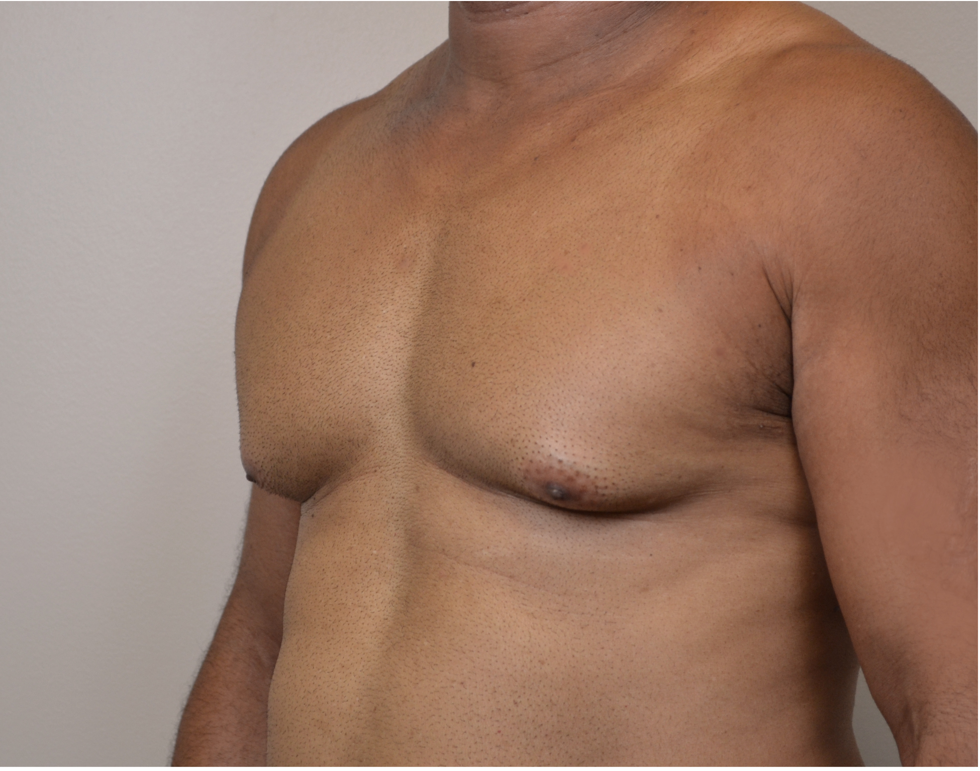 Gynecomastia Before & After Case 5