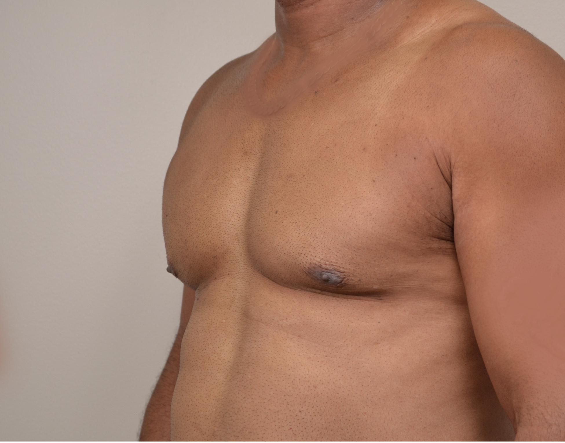 Gynecomastia Before & After Case 5