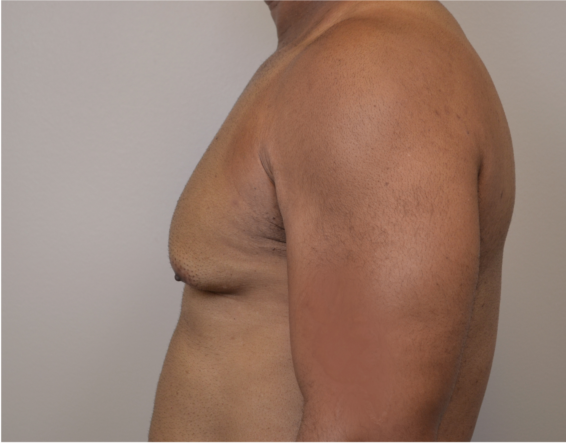 Gynecomastia Before & After Case 5