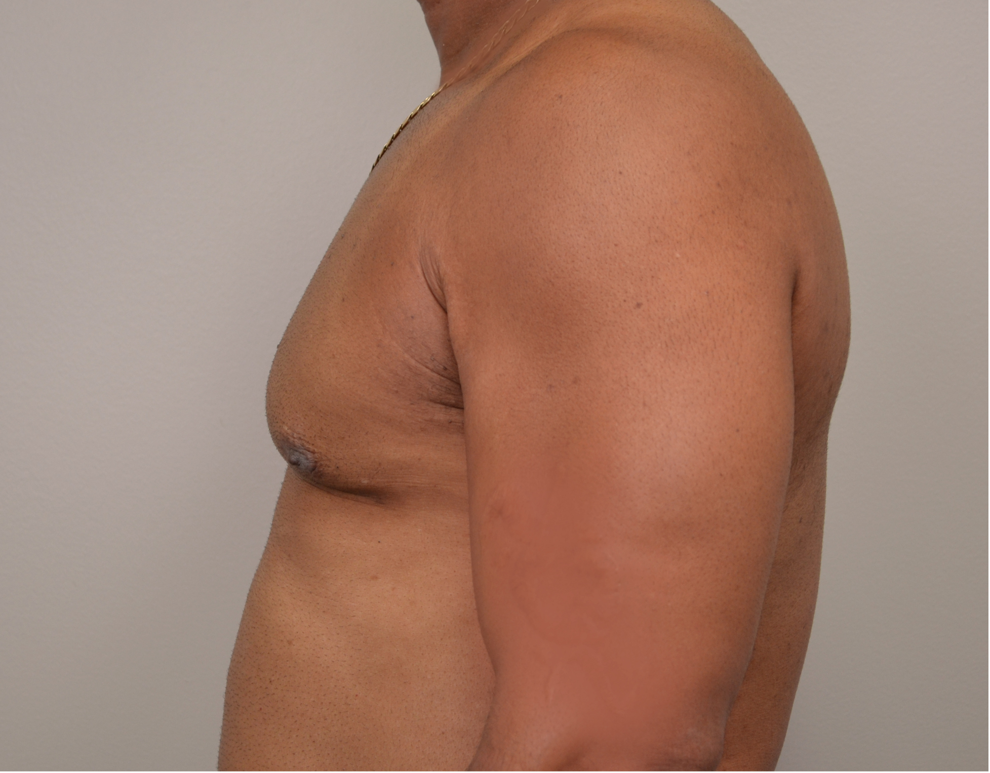 Gynecomastia Before & After Case 5