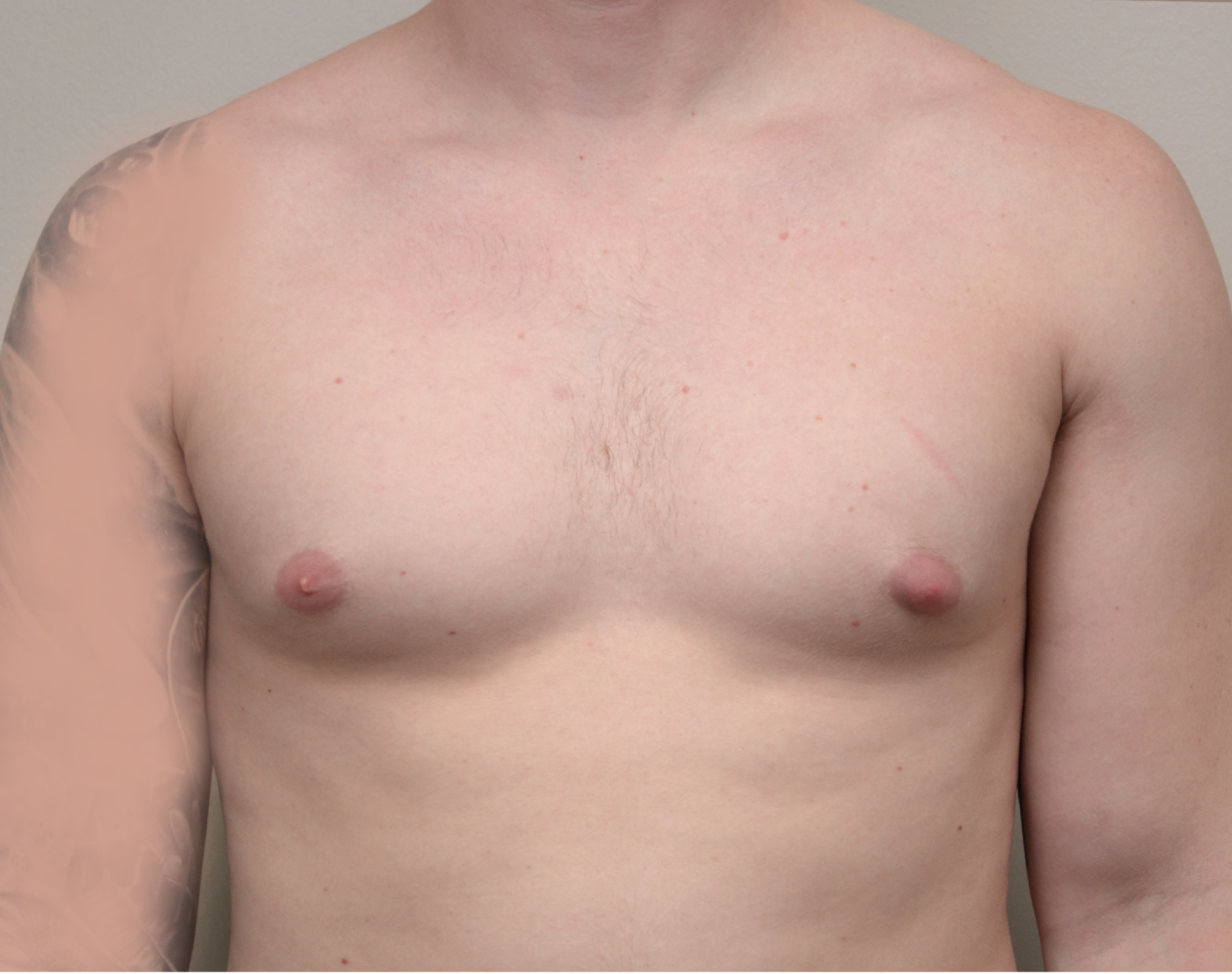 Gyno 37